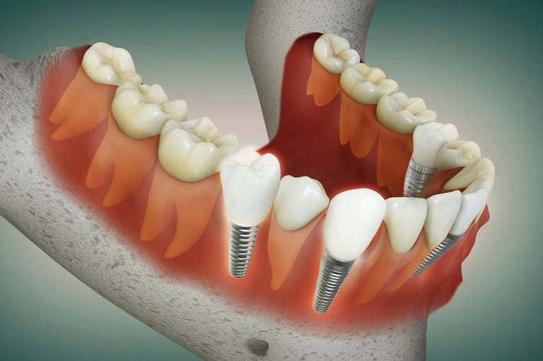 3D rendering image of multiple teeth implant aligning beautifully with healthy teeth-gums and jaw bones