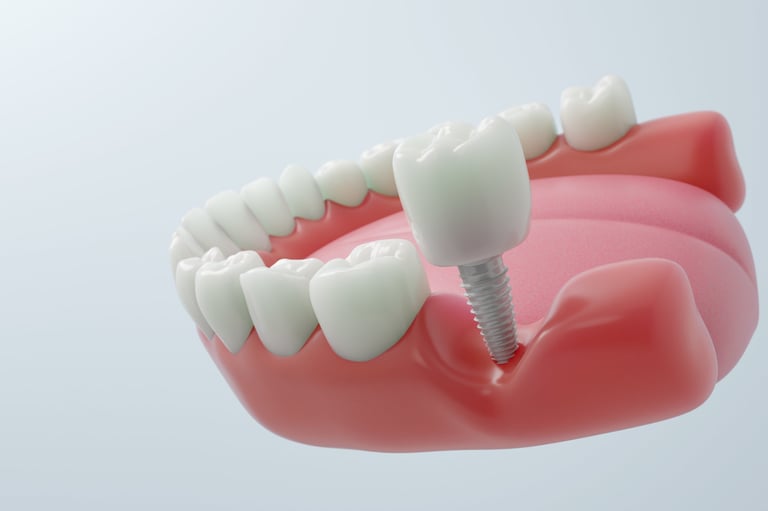 Zirconia ceramic dental implant for a molar tooth, metal free prosthetic for cosmetic dentistry and aesthetic restoration. 3D render.